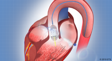 TAVR procedure