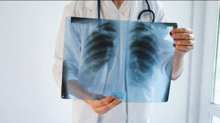 Physician holding chest x-ray