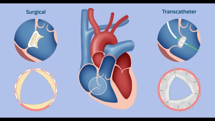tricuspid