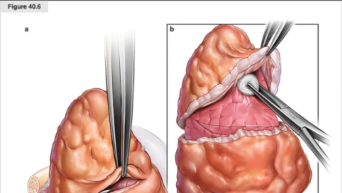 Pleural mesothelioma