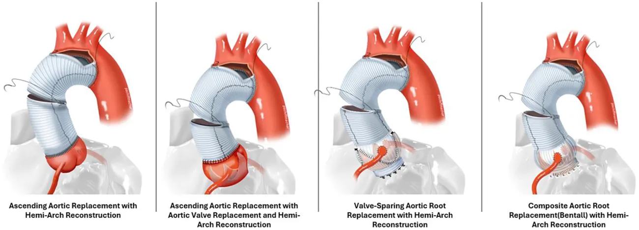 Aorta Graphic for the Risk Calculator