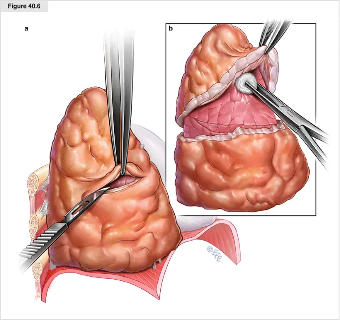 Pleural mesothelioma